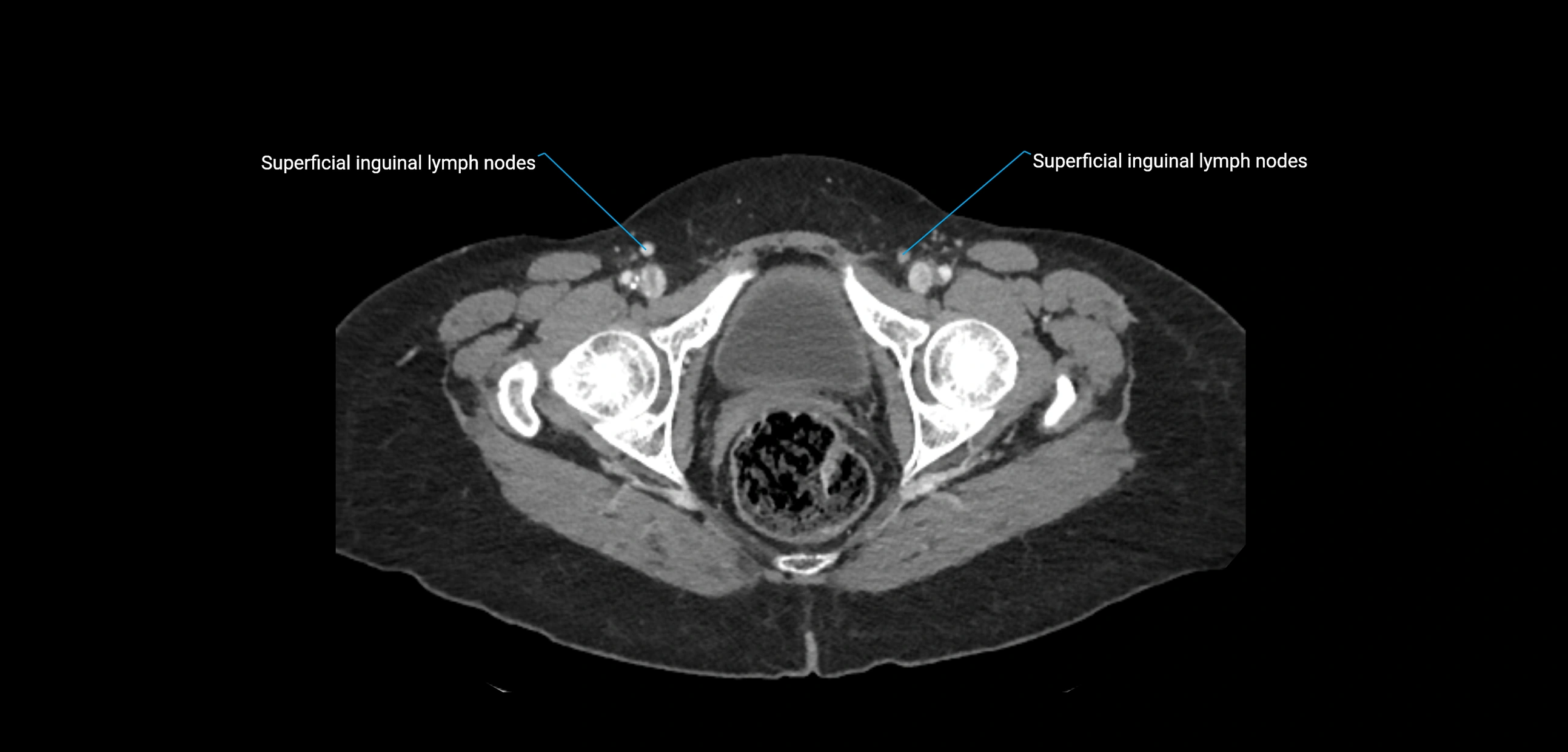 CT ct abdominal lymph nodes  axial cross sectional anatomy  enchanced radiology image -img-00002-00399.webp